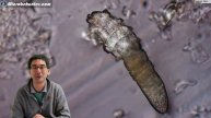 FACE MITES really do live in you | Demodex causing rosacea