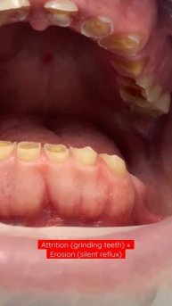 Reflux that happens when asleep plus extreme parafunction (grinding teeth)