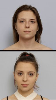 Зачем молодой девушке делать пластическую операцию? #сергейсвиридов #пластическаяхирургия