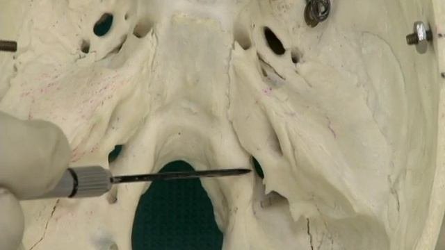 1.14 Step 23.  Foramina Of The Posterior Cranial Fossa
