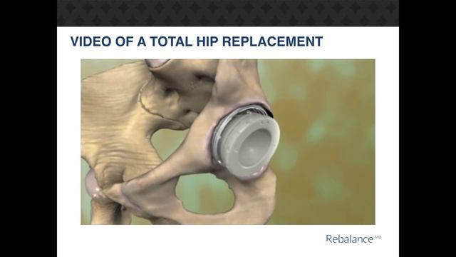 RebalanceMD Total Hip Replacement
