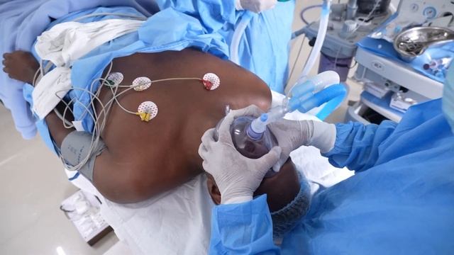 Cleft Patient goes under deep sleep before Anesthesia - Intubation Anesthesia