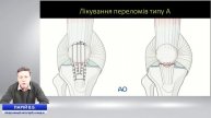 Переломи наколінка (діагностика і лікування).