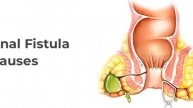 Anal Fistula Best Treatment | symptoms | Reasons in Urdu | Hindi | Baghandar | nasoor ka Desi ilaj