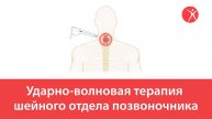 Ударно-волновая терапия шейного отдела позвоночника