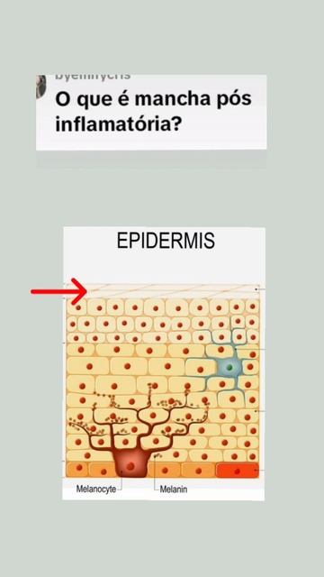 O que é manchas pós inflamatória? (hiperpigmentação pós inflamatória)