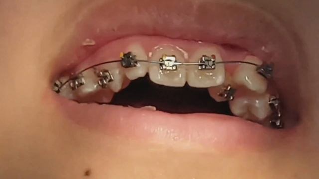SELF LIGATING BRACES|DAMON BRACES|1 MONTH AFTER UPDATE