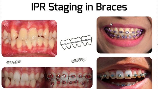 IPR Staging in Braces