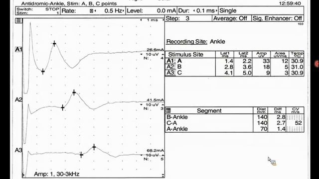 Autoimmune Polyradiculoneurolopathy and a Novel IgG Biomarker