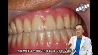 아래쪽 전체틀니 하지마라! 치과의사도 환자도 너무 고생스러워 #틀니 #전체틀니 #치과의사 #임플란트