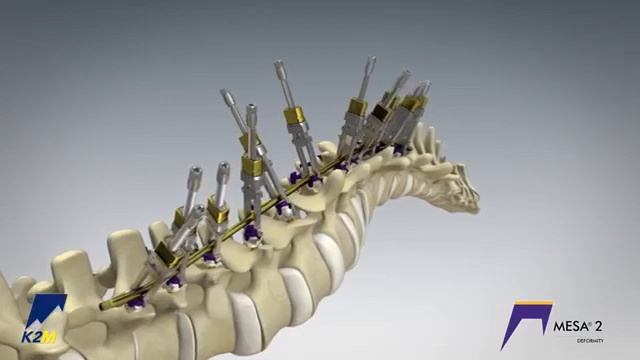 Stryker (K2M): Mesa 2 Dual Differential Correction