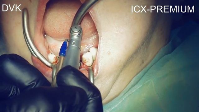 Распаковка и введение импланта 32 . Cистема ICX premium Medentis.