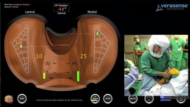 VERASENSE: Addressing Posterior-Medial Tension by Releasing the PCL  Stryker Triathlon