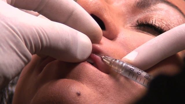 Juvederm Lip Injection Procedure Euro Med Spa with Before and After