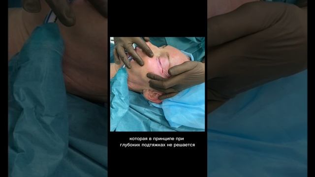 Эндоскопическая подтяжка средней зоны лица совместно с кожной подтяжкой.