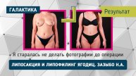 Липосакция и липофилинг ягодиц результат | Зазыбо Николай Александрович