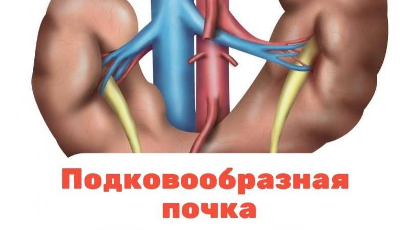 Вопросы-Ответы. Подковообразная почка.