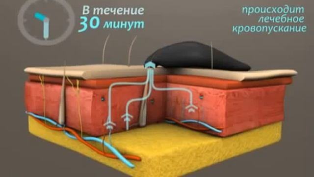 Гирудотерапия лечение пиявками