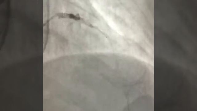 Стентування ПМШГ в гострій стадії інфаркту міокарда