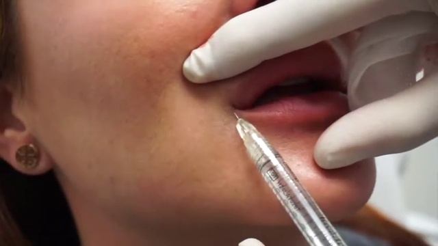 Natural Lip Enhancement By Dr. Lily