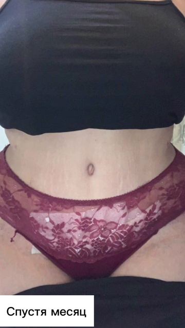 Результат абдоминопластики.