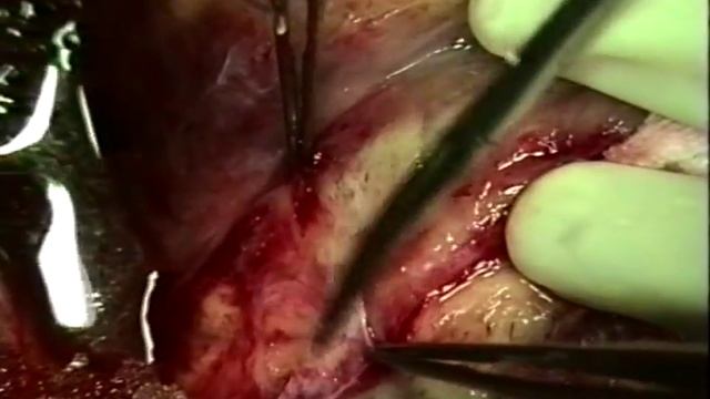 Повторная реваскуляризация миокарда, проф.Б.В.Шабалкин © Repeated myocardial revascularization