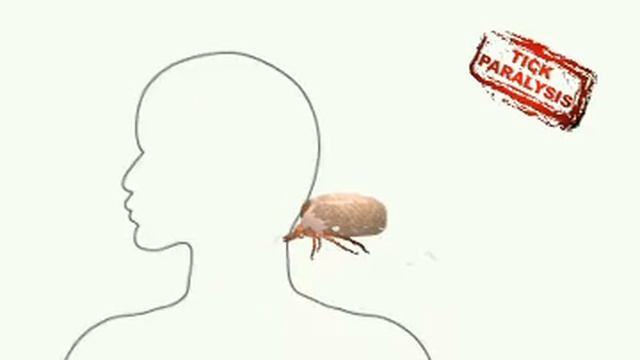 Tick Paralysis (Its Educational)
