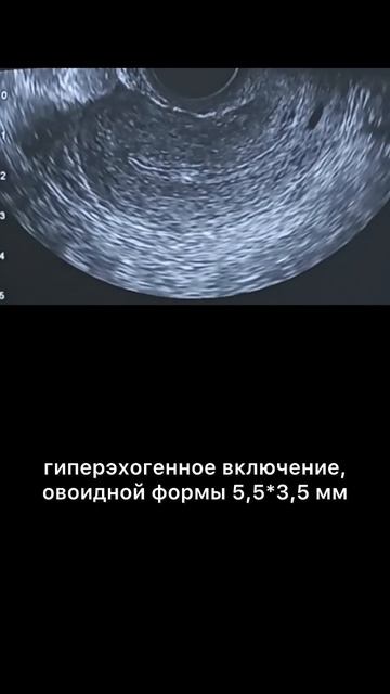 #полип эндометрия