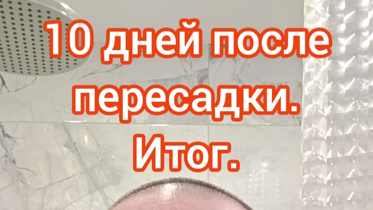 Пересадка волос. 10 день после пересадки.  Финал.