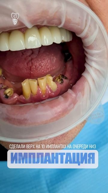 Сделали верх на 10 имплантах на очереди низ. Upper jaw was made with 10 implants the bottom is next
