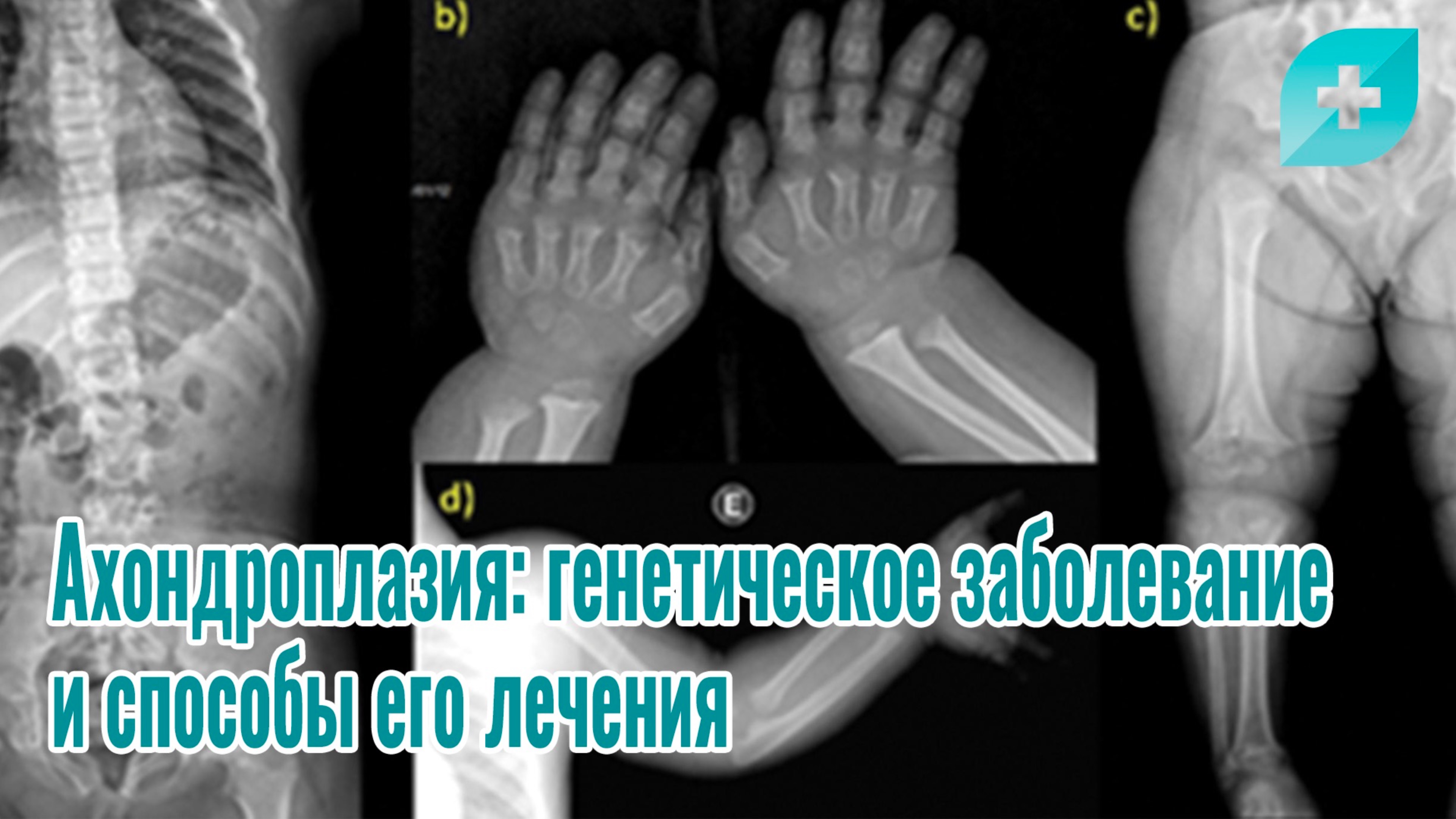 Ахондроплазия: генетическое заболевание и способы его лечения