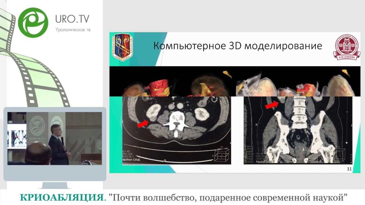 КРИОАБЛЯЦИЯ. Почти волшебство, подаренное современной наукой