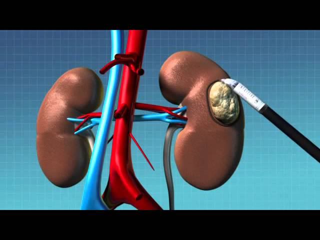 Robotic Partial Nephrectomy Animation