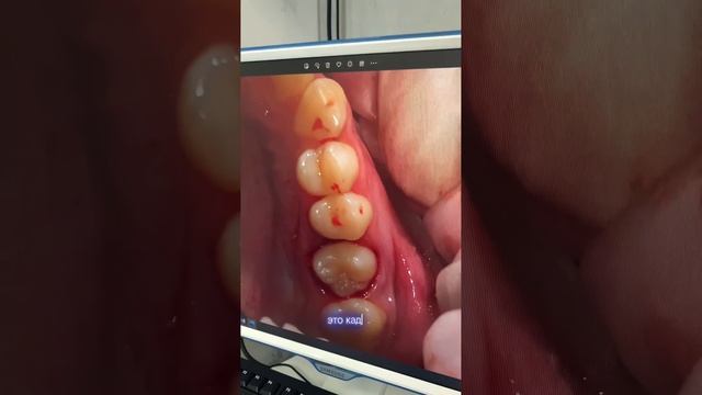 Аутотрансплантация