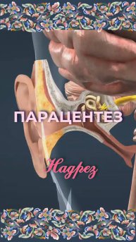 Парацентез