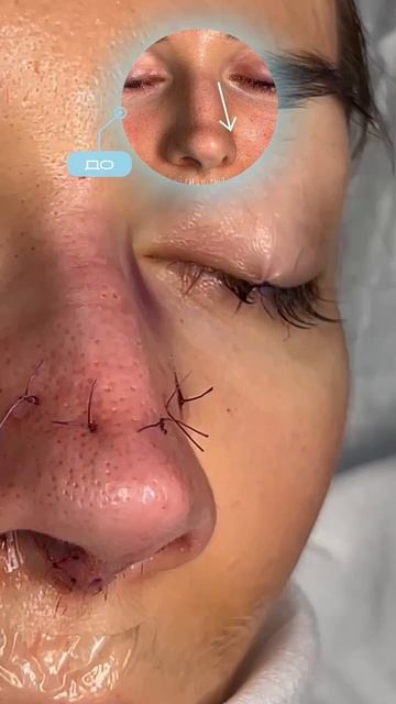 Первичная риносептопластика 👃🏼