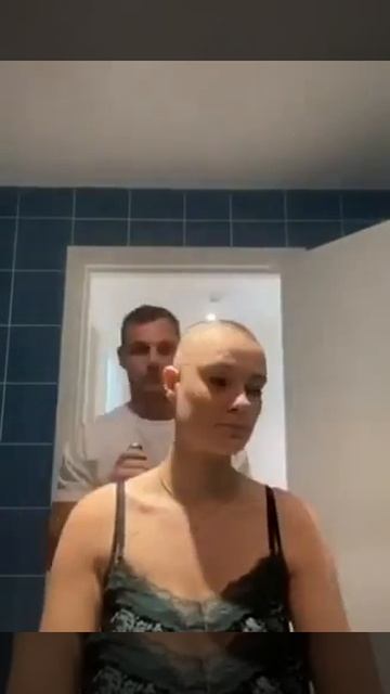 Девушка, страдающая алопецией