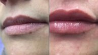 СЕКСИ УСТНИ ХИАЛУРОН 1ml.