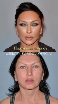 Выполнил пациентке невидимую подтяжку лица!
