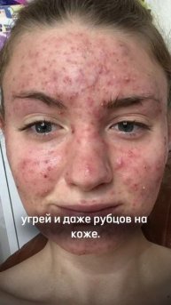 Как вылечить подростковые акне и прыщи