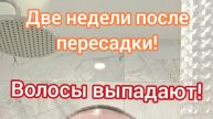 Пересадка волос. Две недели после пересадки.