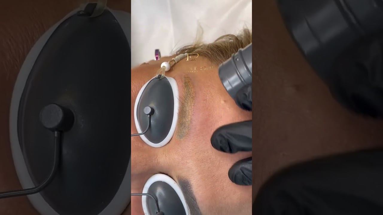 Удаляем серый татуаж бровей  #brows #microblading #beauty #lips
