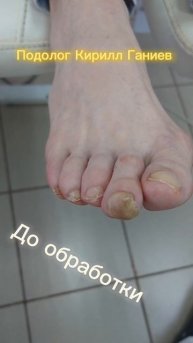Обработка грибка ногтей