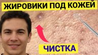 Шагреневая от Прыщей Кожа, Сальники накопились и Выдавливаются. Мастер аккуратен и очистил лицо чётк