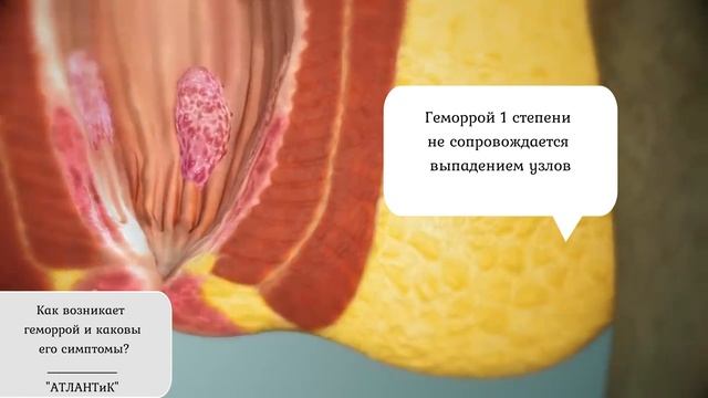 Как возникает геморрой и каковы его симптомы?