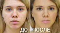 Как быстро избавиться от АКНЕ...?👀