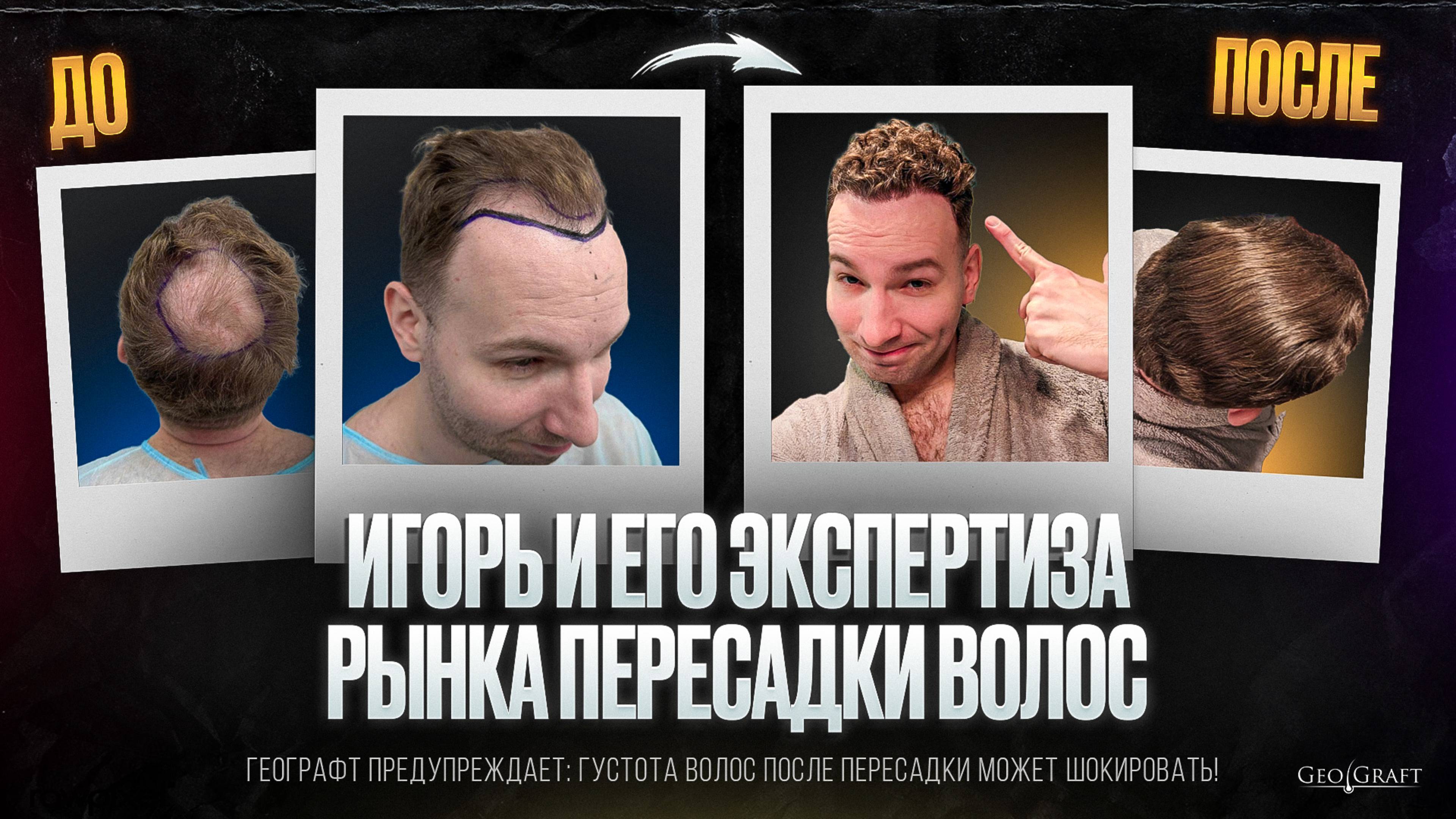 Игорь и его экспертиза рынка пересадки волос. Выбор Игоря - ГеоГрафт