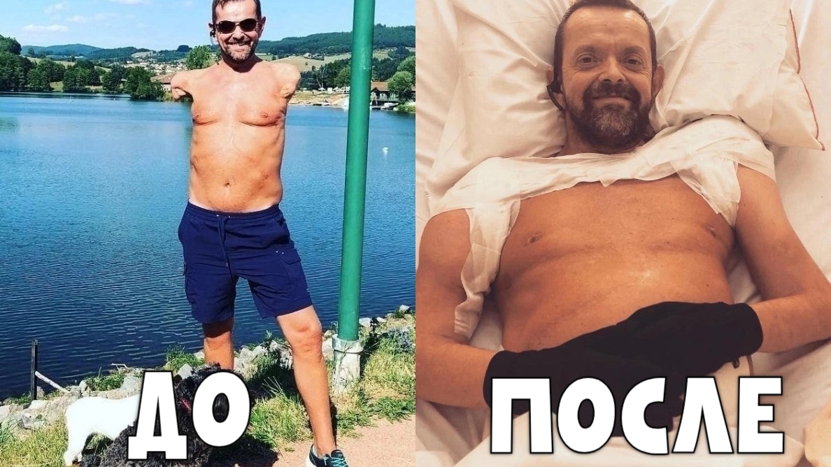 ПЕРВЫЙ человек, которому пришили ОБЕ РУКИ