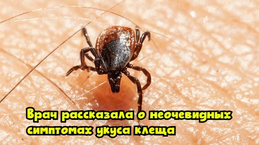 Врач рассказала о неочевидных симптомах укуса клеща