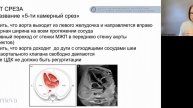 5.7. Лекция. Срез через выносящий тракт левого жел